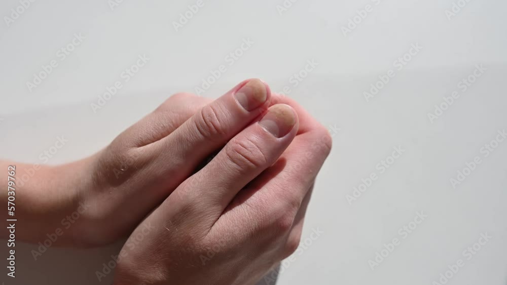 Hands with nail lesions onycholysis, on a white background