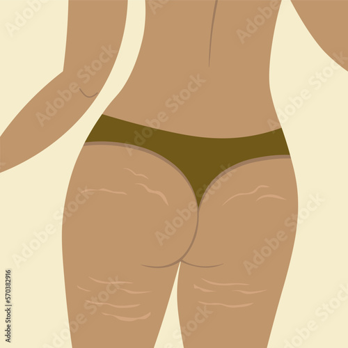 Woman with cellulite. Body Positive.Women's hips with stretch marks. Self love and positive body concept. Weight loss after exposure. Vector illustration in flat style