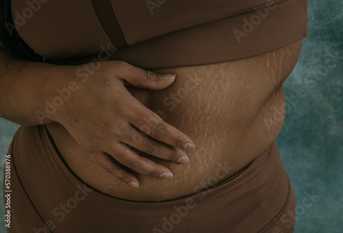 close up of East Indian hand on tummy with stretchmarks photo