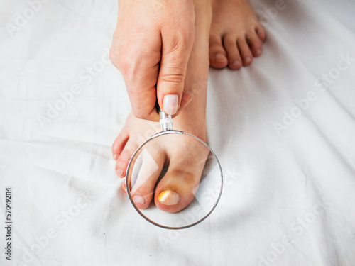 woman examines the fungus on the toenail through a magnifying loupe,diagnosis of nail fungus, toe nail fungus