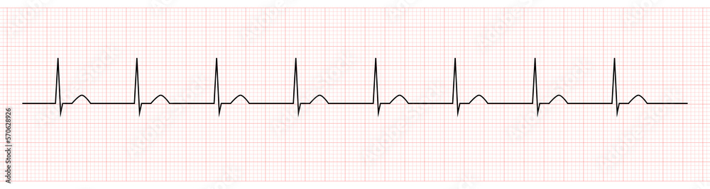 EKG Monitor Showing accelerated junctional rhythm