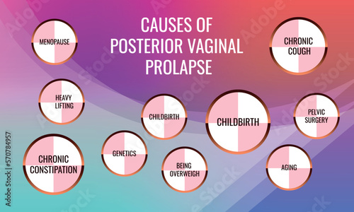 Causes of Posterior vaginal prolapse. Vector illustration for medical journal or brochure.