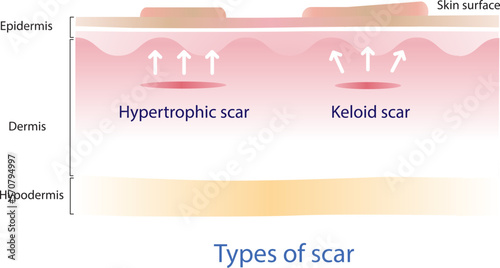 Type of keloid scar and hypertrophic scar on skin surface. Scars are caused by wounds that reach the dermis layer.