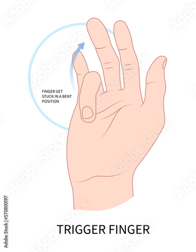 wrist of Dupuytren's gout diabetes index lock tendon bump nodule middle ring bump anatomy medical hand cyst flexor pain bend get stuck sheath inflamed swollen palm lump muscle examine join bone 