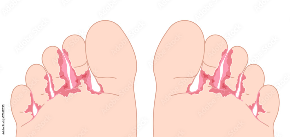 foot fungus bacteria toe Itchiness with and jock itch symptom smell bad of Athlete's pus
