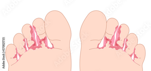 foot fungus bacteria toe Itchiness with and jock itch symptom smell bad of Athlete's pus