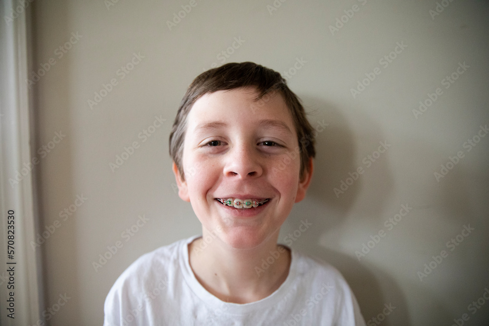 Tween Boy With Red and Green Braces Grins At Camera, Close Up Tween Boy With Red and Green Braces Grins At Camera, Close Up