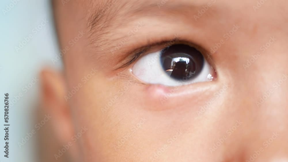 closeup-of-infected-child-eye-patch-with-painful-bump-on-lower-eyelid