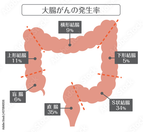人間の体_大腸がんの発生率