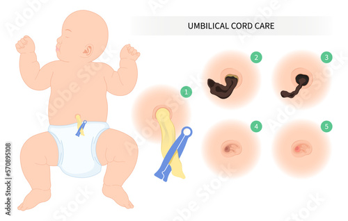 after birth weeks cleaning umbilicus dry pus swollen fall off scar tissue