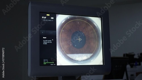 Laser operation in laser eye surgery, close eye shot from monitor stock video. Whole process of eye lasering and scanning on monitor. photo