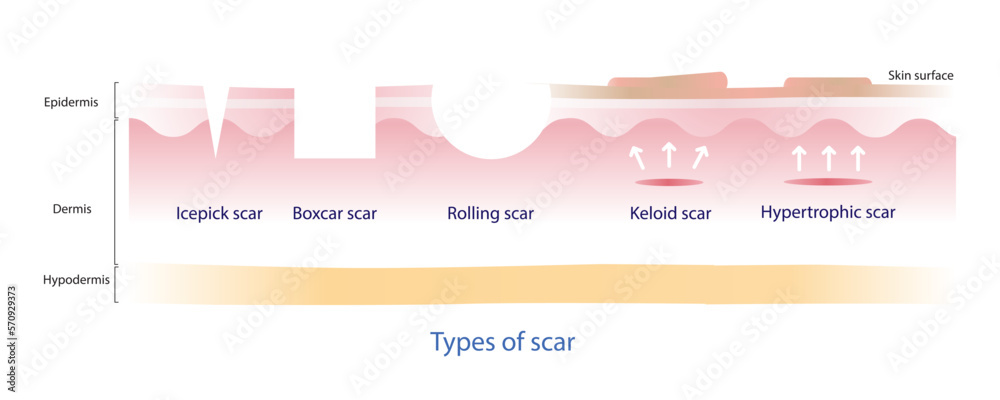 Types of scar vector, icepick scar, boxcar scar, rolling scar, keloid ...
