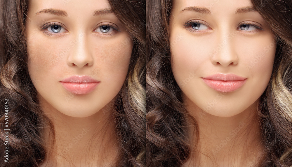 Dark spots, freckles,hyperpigmentation(melasma or chloasma),concept - skin lightening, skin whitening, fruit acids,AHA, Skin Brightening Dark spots, freckles,hyperpigmentation(melasma or chloasma),concept - skin lightening, skin whitening, fruit acids,AHA, Skin Brightening
