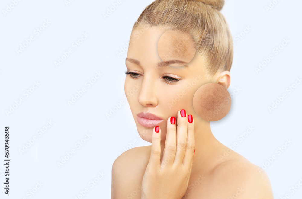 Dark spots, freckles,hyperpigmentation(melasma or chloasma),concept - skin lightening, skin whitening, fruit acids,AHA, Skin Brightening Dark spots, freckles,hyperpigmentation(melasma or chloasma),concept - skin lightening, skin whitening, fruit acids,AHA, Skin Brightening