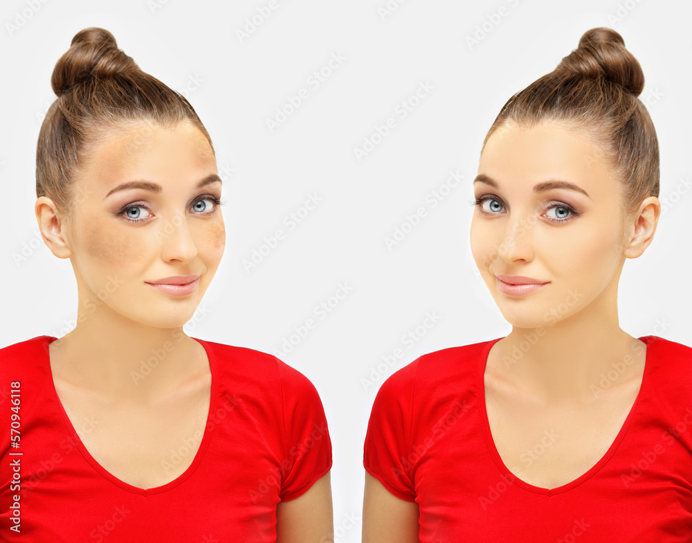 Dark spots, freckles,hyperpigmentation(melasma or chloasma),concept - skin lightening, skin whitening, fruit acids,AHA, Skin Brightening Dark spots, freckles,hyperpigmentation(melasma or chloasma),concept - skin lightening, skin whitening, fruit acids,AHA, Skin Brightening