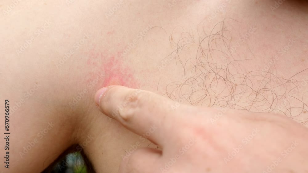 Man chest with red, swollen bump from mosquito bite Man chest with red, swollen bump from mosquito bite