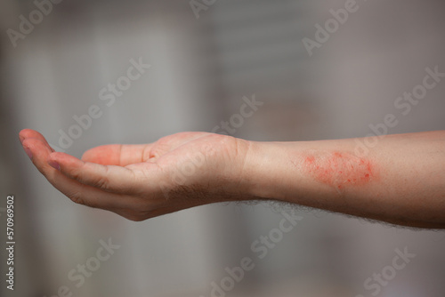 Spots, sores on human skin. Infection rash, psoriasis, eczema, lichen. Allergies and dermatitis. Work injury. scorch © Vera
