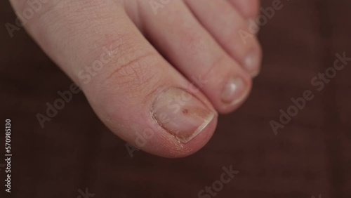 foot with damaged nails because of fungus. Onycholysis, exfoliation photo