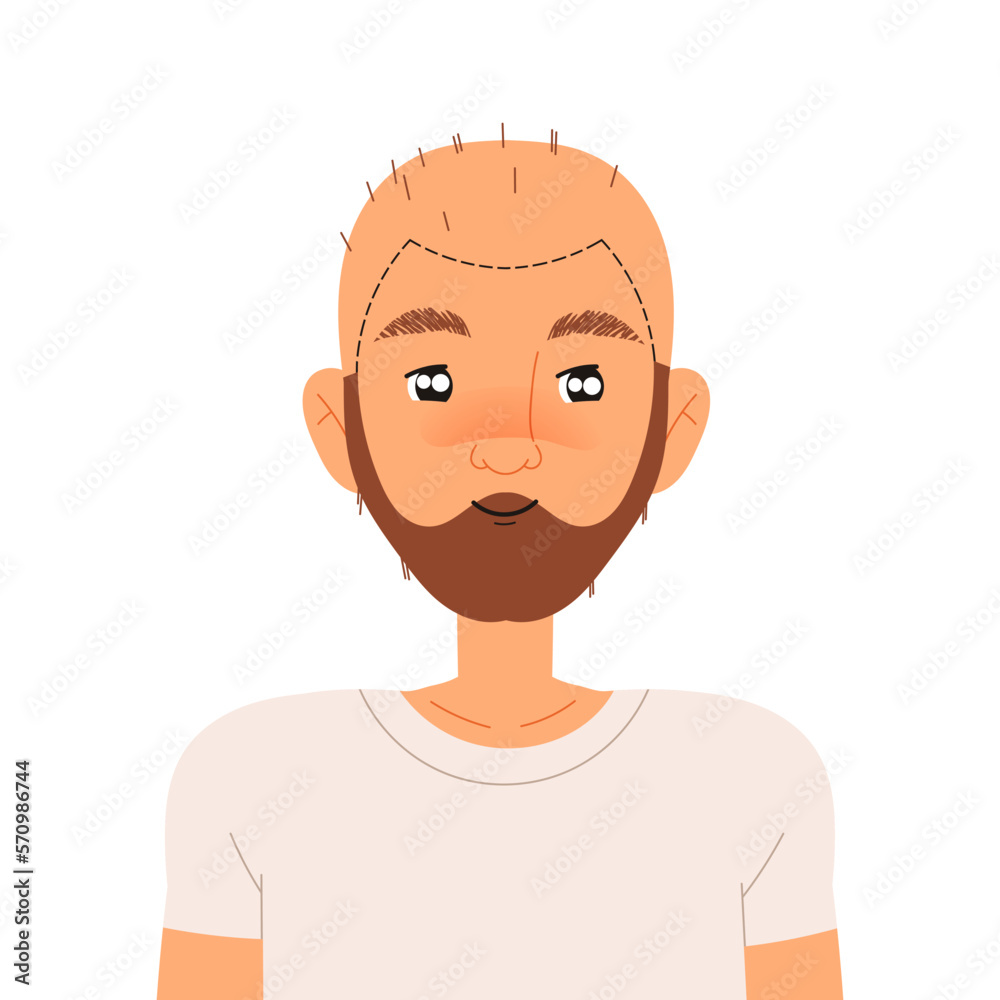 Man Character Doing Hair Transplantation Suffer from Alopecia or Baldness Vector Illustration