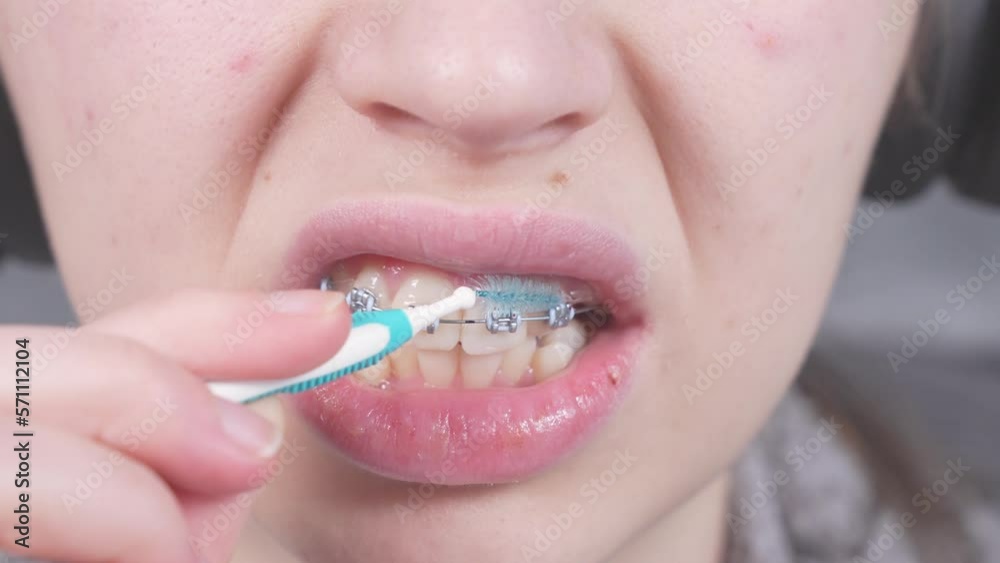 Teenager brushing metal brackets by orthodontic toothbrushes, dental