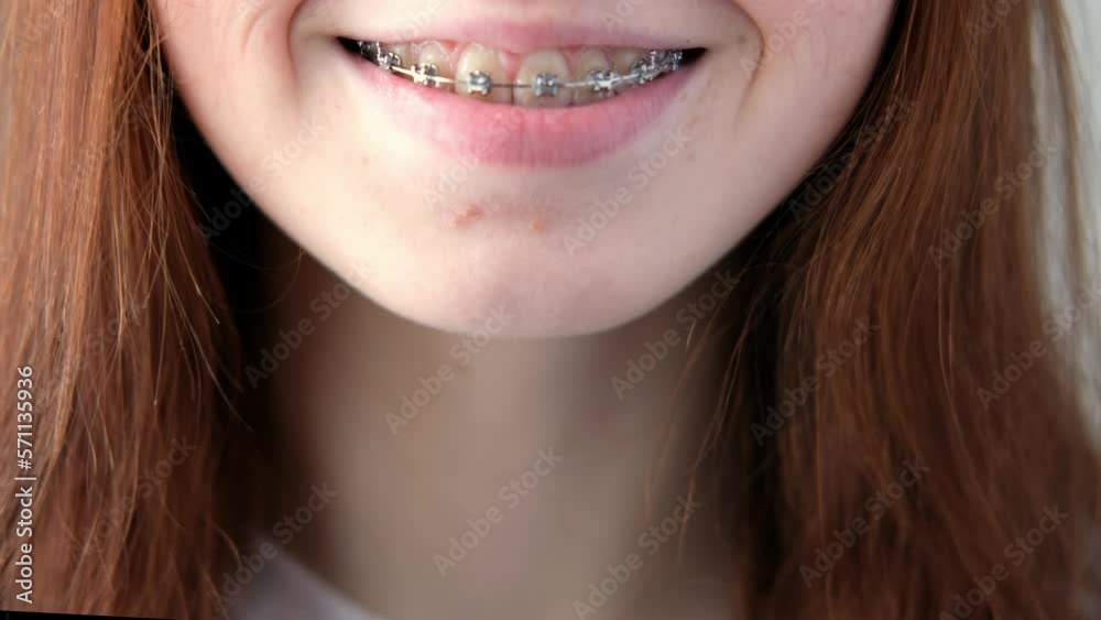smile red-haired girl in braces close-up smile red-haired girl in braces close-up