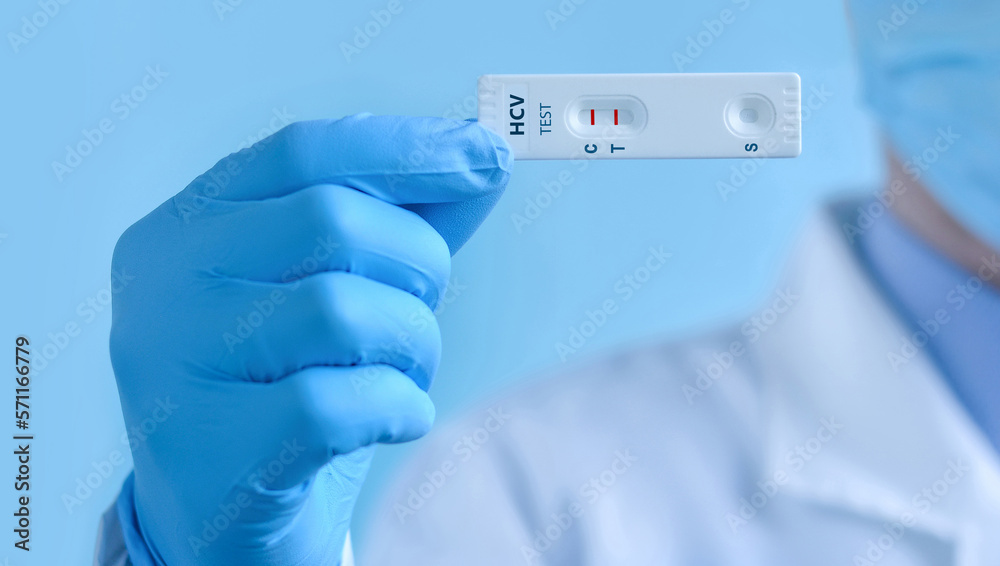 A doctor wearing protective mask and gloves shows a rapid laboratory test for hepatitis C virus (HCV) . The test shows a positive result. - obrazy, fototapety, plakaty 