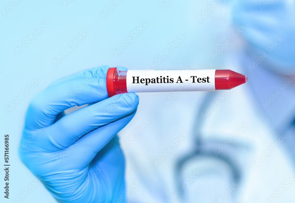 Fototapeta premium Doctor holding a test blood sample tube positive with hepatitis A virus (HAV) test.