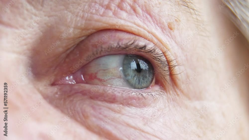 Ophthalmology. Sick Eye with dilated blood vessels of an old woman. Eye