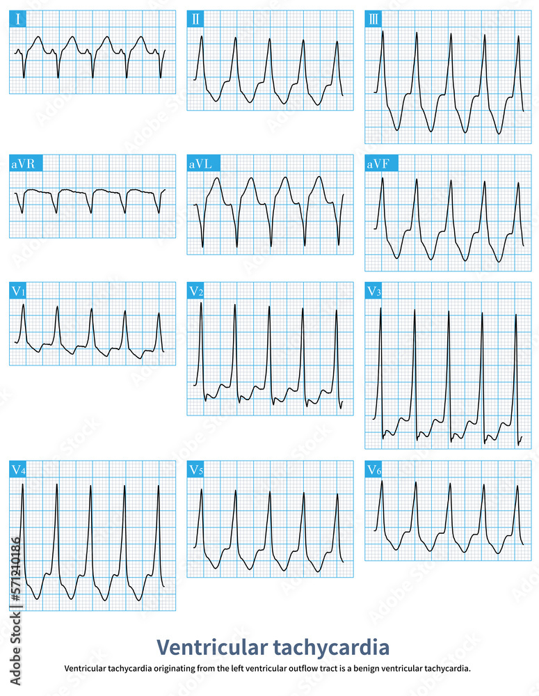 Ventricular tachycardia originating from the left ventricular outflow
