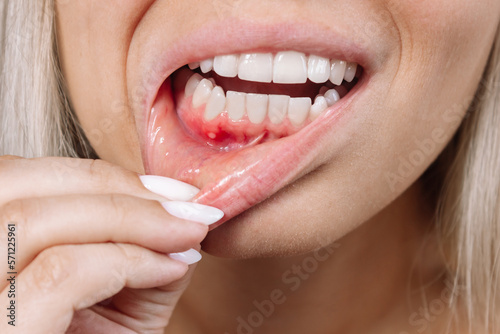 Ulcerative stomatitis on the gums. Gum inflammation. Close up of young blonde woman showing red bleeding gingiva with an ulcer holding her lip. Dentistry, dental care, lesion photo