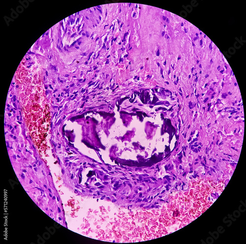 Oral submucous fibrosis (OSF), abnormal collagen deposition. precancerous disorder and transforms. Photomicrograph, photo