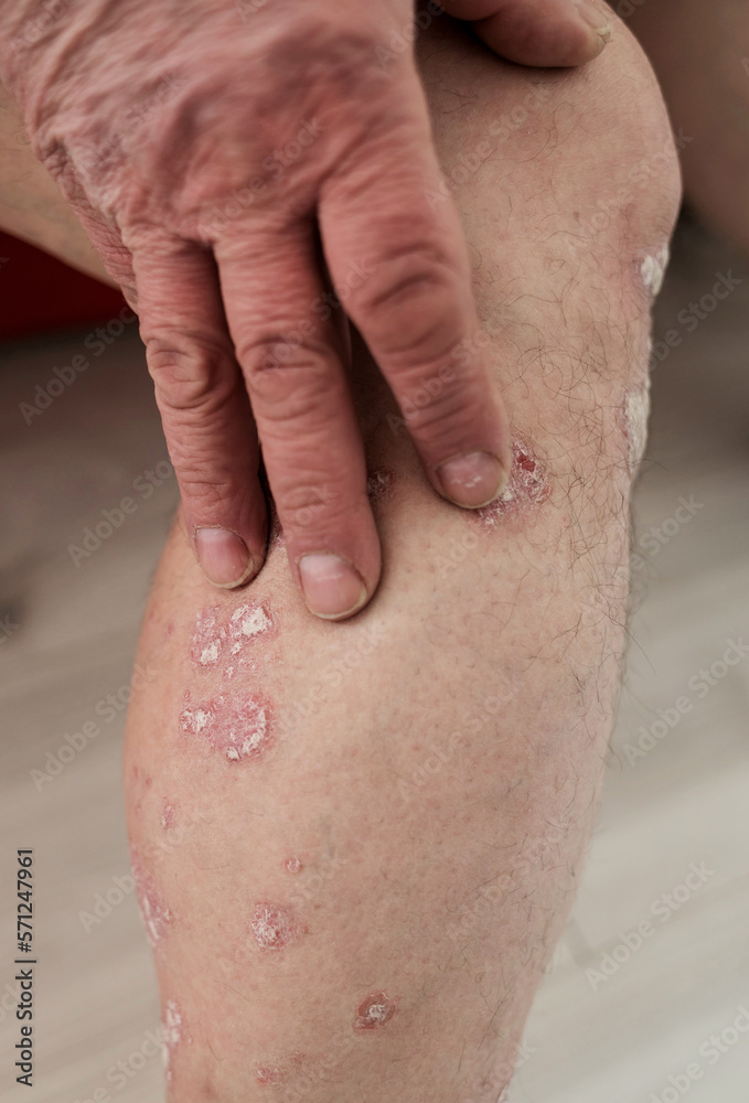 Fototapeta premium man hand scratching allergy rash