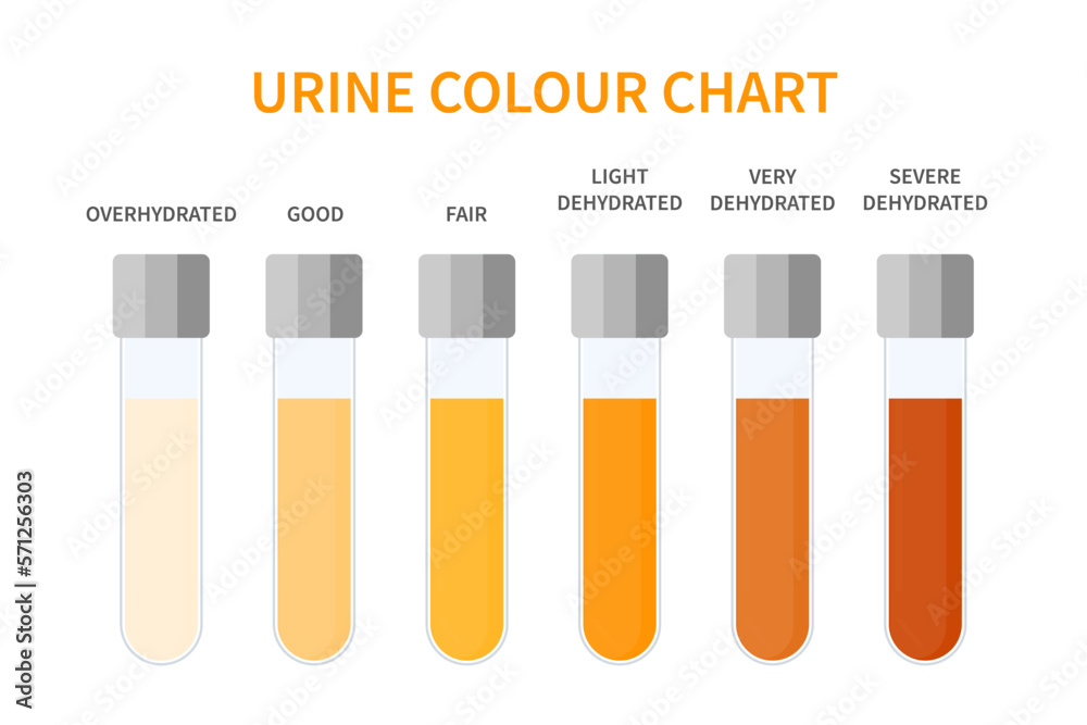 Urine colour chart. Hydration and dehydration level diagram. Medical urinal test kit for urinary tract infection research. Containers with yellow to brown pee for urinalysis. Vector illustration. Urine colour chart. Hydration and dehydration level diagram. Medical urinal test kit for urinary tract infection research. Containers with yellow to brown pee for urinalysis. Vector illustration.