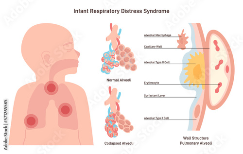 Infant respiratory distress syndrome. Congenital pathology of baby's photo
