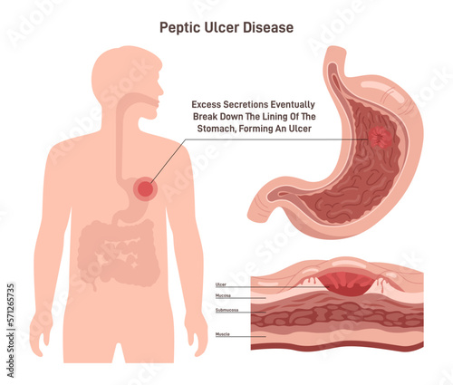 Peptic ulcer disease. Stomach wall with a sore on the lining. Digestive