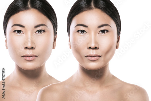 Female face comparison after buccal fat extraction plastic surgery photo