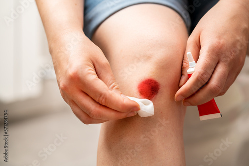Fotografie Close-up of a woman with a gauze and disinfectant liquid treating a knee injury
