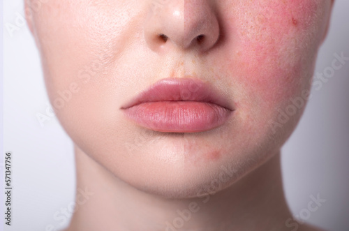 rosacea couperose redness skin, red spots on cheeks, young woman with sensitive skin, patient face before after result close-up  photo