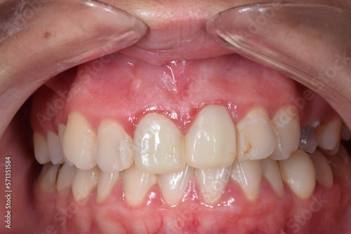 Fixed prosthetic crowns in central incisors. Frontal view of maxillary arch incisor and canine teeth, gum inflammatory. Cheeks and lips retracted with transparent cheek retractor.