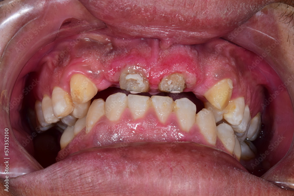 Front view of decayed broken incisors, dental roots and inflammatory red bleeding gingival gum with bad posterior dental occlusion. Cheeks and lips retracted with cheek retractor.