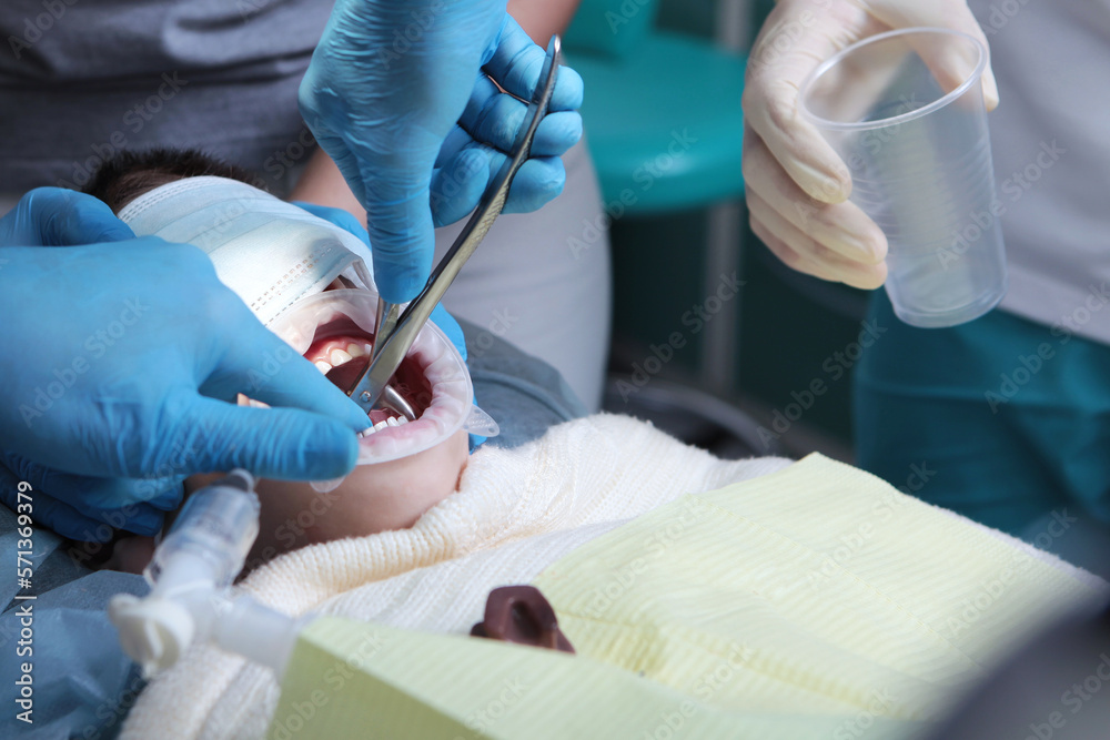 Treatment of baby teeth. Installation of crowns on baby teeth. The child is under general anesthesia. Dental services for children.Concept of dental services. Treatment of baby teeth. Installation of crowns on baby teeth. The child is under general anesthesia. Dental services for children.Concept of dental services.