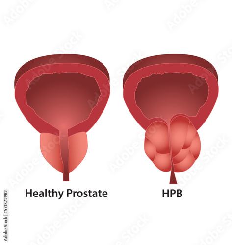 Prostate - Próstata