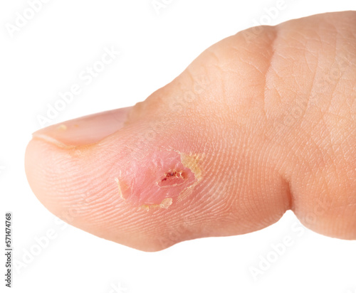 Wound on a man s finger. Macro