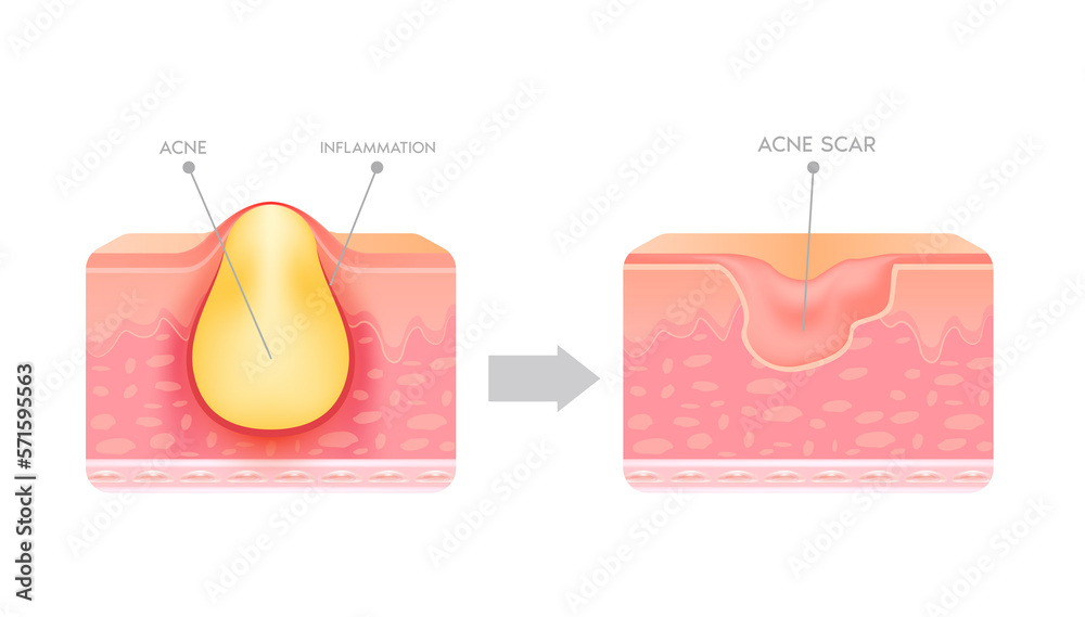 How Do Scars Develop Acne scar vascular laser treatment. Inflammation associated with ...