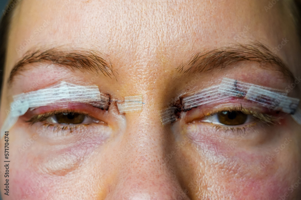 close up woman eyes after plastic surgery, cuts with dried blood, skin