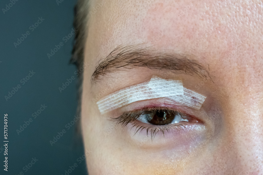 close up woman eyes after plastic surgery, yellow red color skin