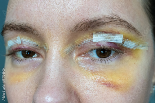 Fotografie close up woman eyes after plastic surgery, yellow red color skin bruising, bleph