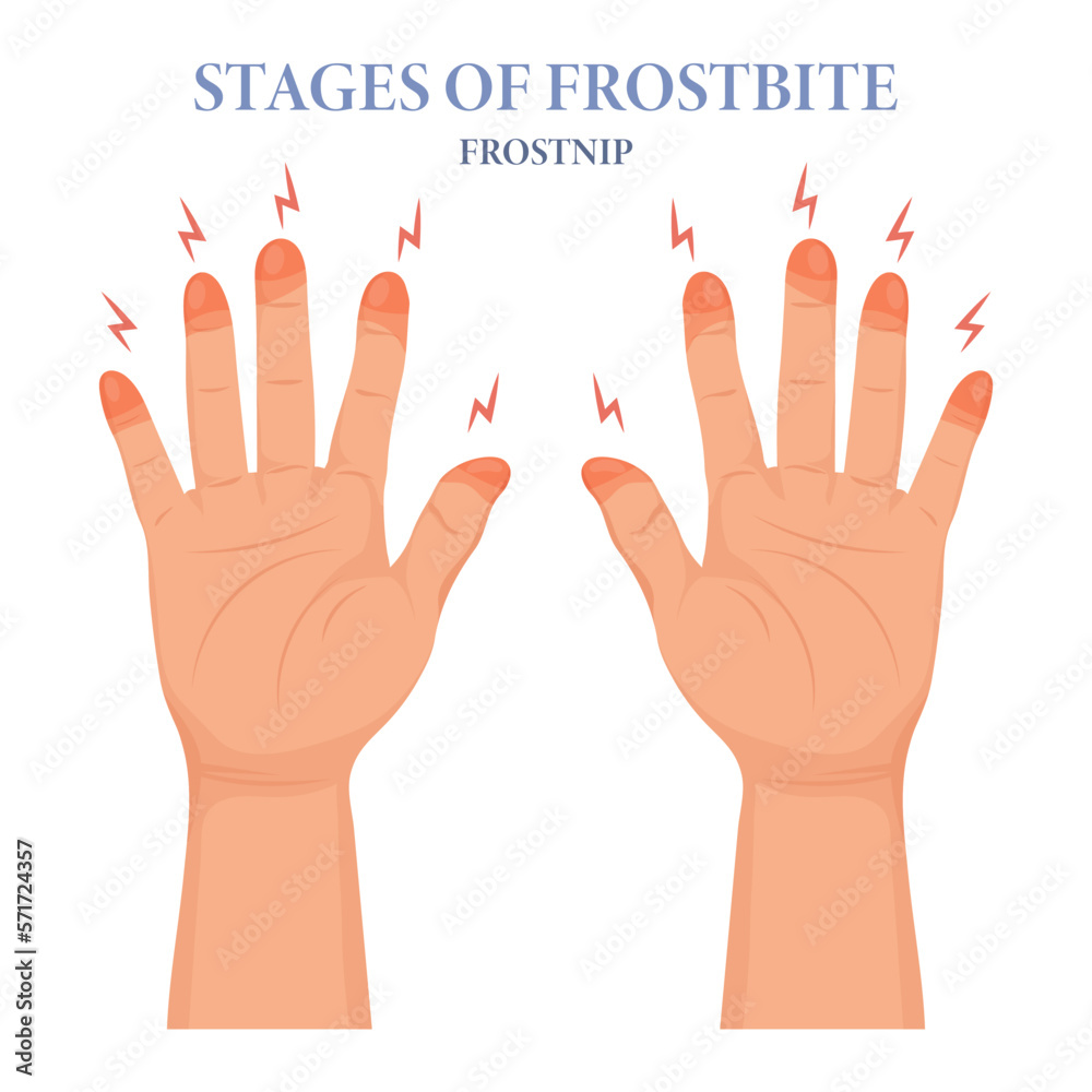 Frozen hands in different stages. Medical frostbite. Stages of