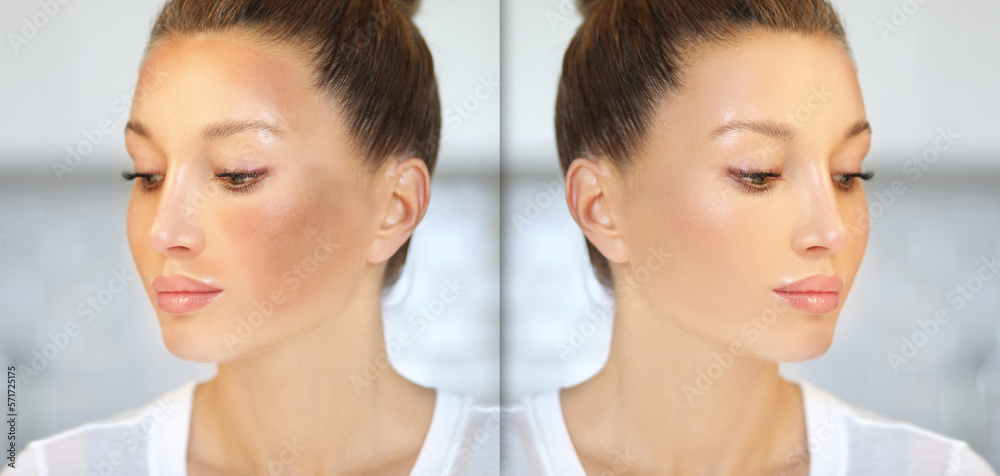 Dark spots, freckles,hyperpigmentation(melasma or chloasma),concept - skin lightening, skin whitening, fruit acids,AHA, Skin Brightening Dark spots, freckles,hyperpigmentation(melasma or chloasma),concept - skin lightening, skin whitening, fruit acids,AHA, Skin Brightening