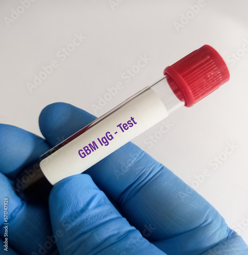 Blood sample for Glomerular Basement Membrane Antibody or GBM IgG test to diagnosis of asture’s Syndrome (Anti-GBM disease). photo